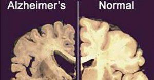 Alzheimer_t670x470