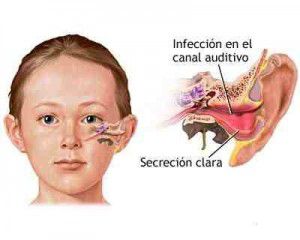 otitis (1)