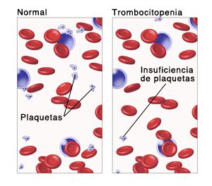 Cross section of blood vessel with normal amounts of red blood cells, platelets, and white blood cells in plasma. Below it is another cross section of blood vessel with thrombocytopenia showing normal amounts of red blood cells, white blood cells, and too