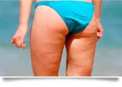 celulitis blanda