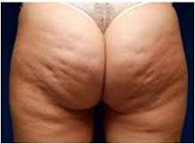 celulitis edematosa