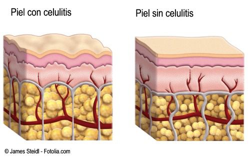 piel con celulitis