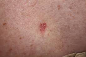 melanoma