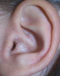 Consejos para prevenir la otitis del nadador