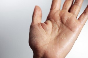 l-carnitina-efectos-secundarios-hiperhidrosis