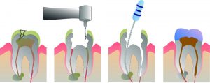 roturas endodoncias normal