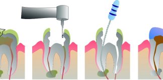 roturas endodoncias normal