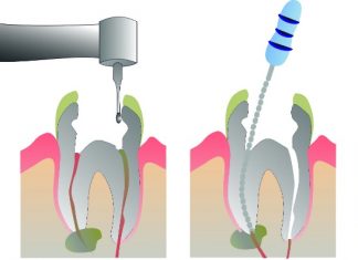 Endodoncias ¿porqué se rompen? roturas endodoncias normal